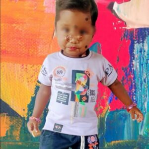Help Baby Madhu Receive Life-Changing Facial Reconstructive Surgery